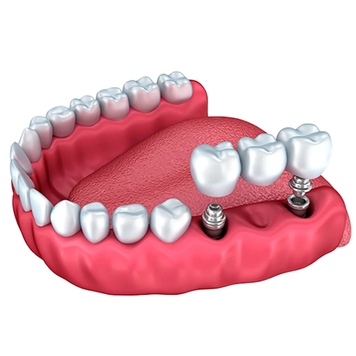 Perdi vários dentes